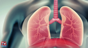 Lung transplant surgery providing a life-saving option for selected cancer patients with severe lung disease.